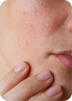 Primo piano di pelle leggermente rossa e pori visibili, espressione neutra in primo piano.