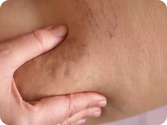 Comparsa di vene varicose o teleangiectasie su pelle chiara, coperte parzialmente da dita che sostengono la zona.